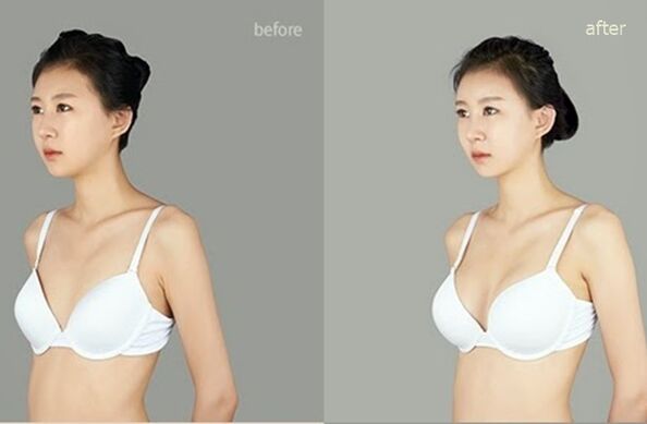 voor en na plastische borstvergroting