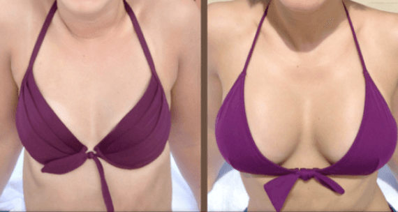 Voor en na een borstvergroting