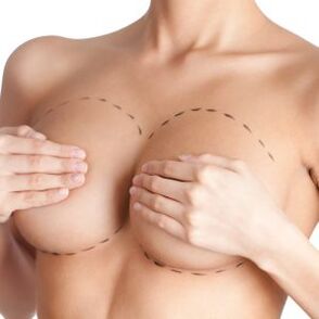 Soorten implantaten