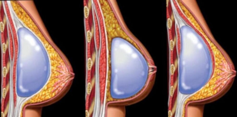 Installatie van implantaten