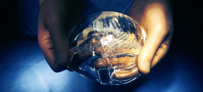 Siliconen endoprothese